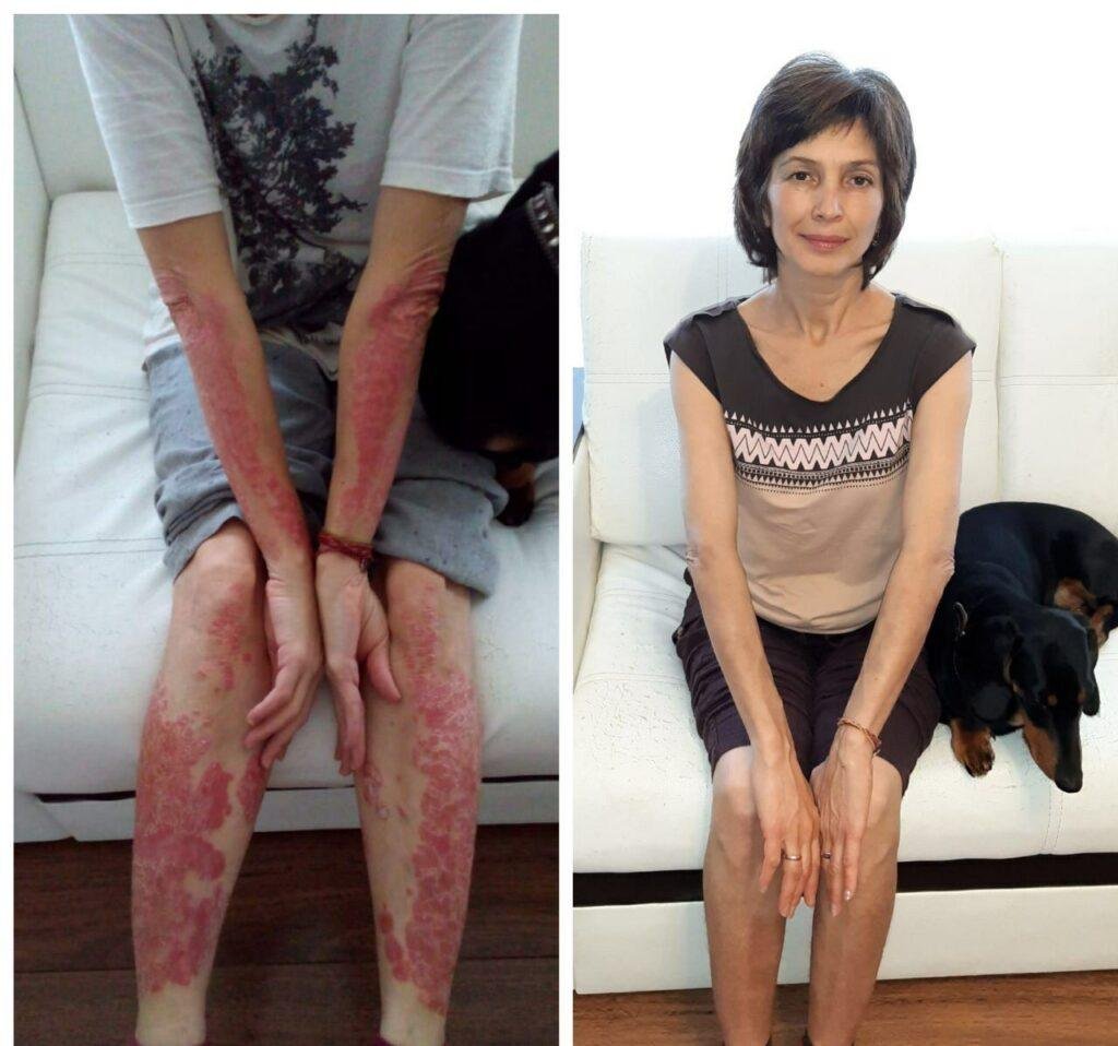 Gulnara G. before and after bioresonance and natural supplement programme — skin condition cleared after 4 months