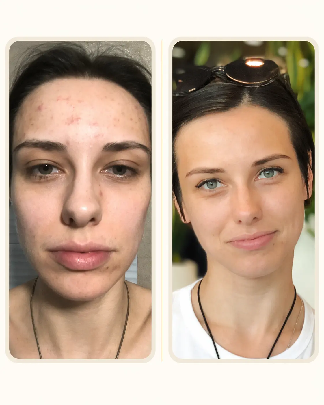 Alexandra — acne cleared