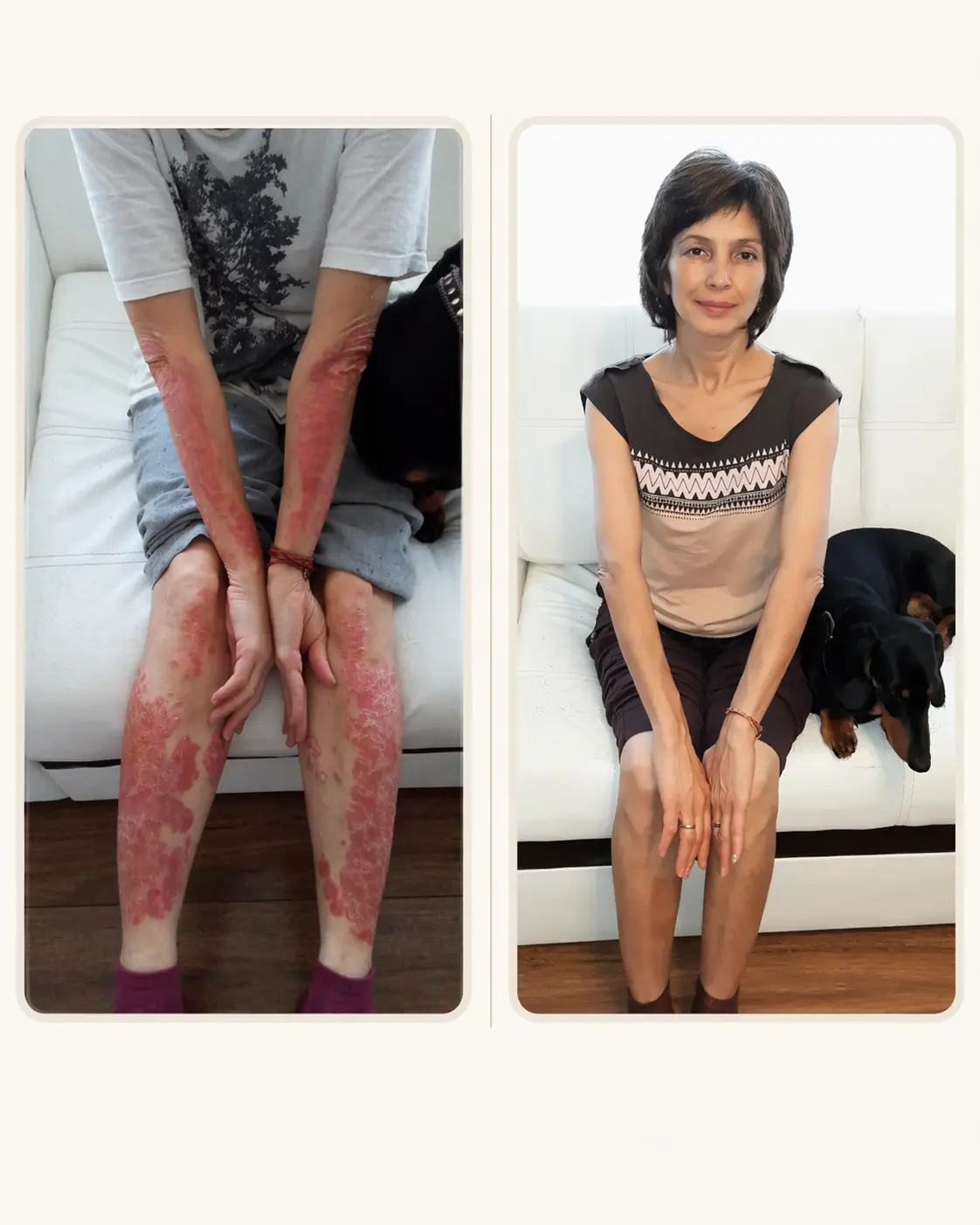 Gulnara — psoriasis cleared after 40 years